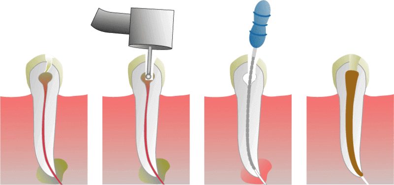 Root Canal Treatment in Nagpur
